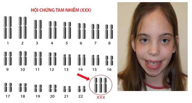 Xet Nghiem Nipt Phat Hien Benh Gi 3