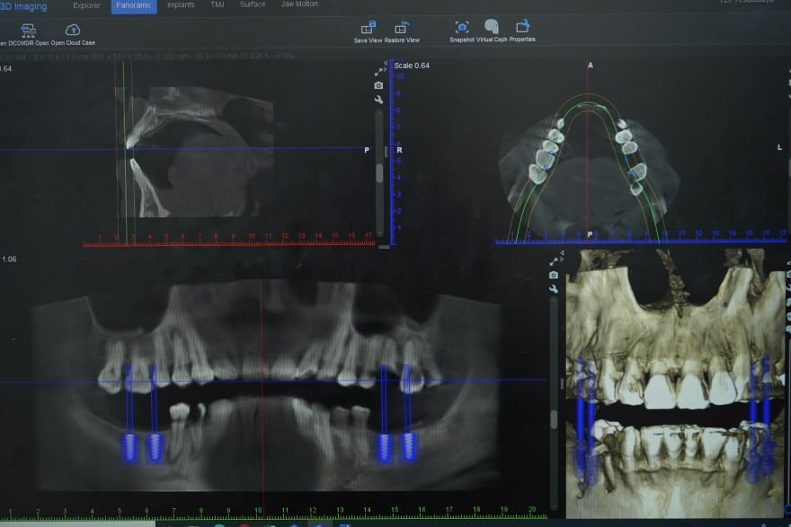 trồng răng implant