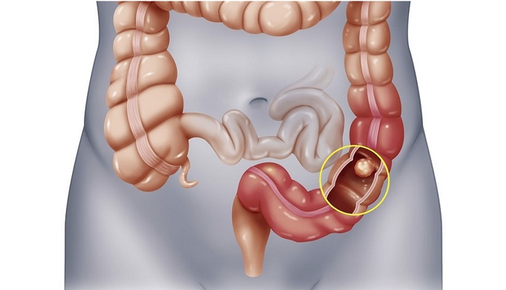 Ung thư đại trực tràng là căn bệnh khá phổ biến ở Việt Nam