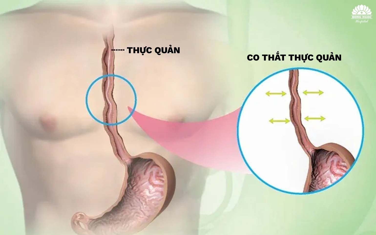 Esophageal spasm is a motility disorder of the esophageal smooth muscle.