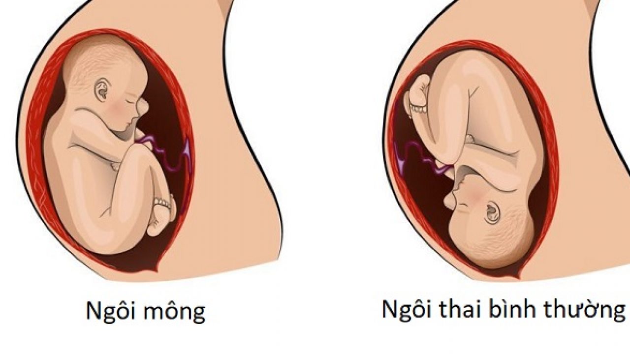 Thai nhi ngôi mông