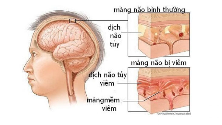 Bệnh thủy đậu ở trẻ em
