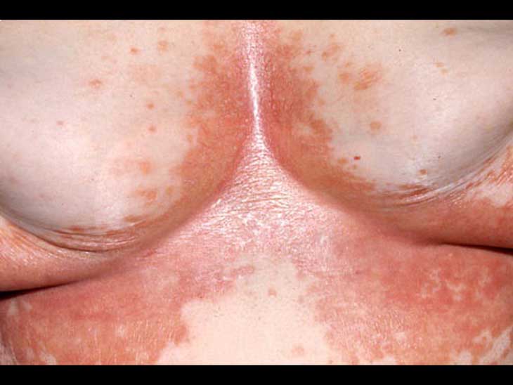 bệnh về da trong mùa mưa lũ