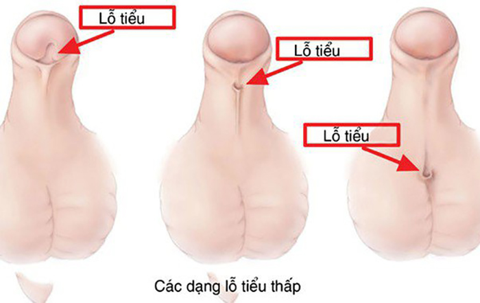 dị tật đường tiết niệu