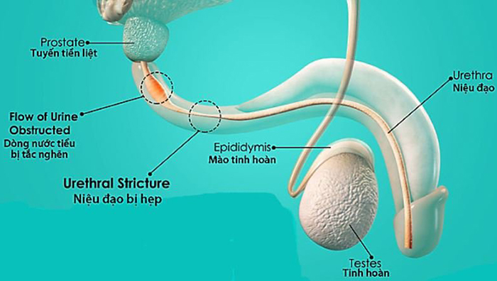 hẹp niệu đạo