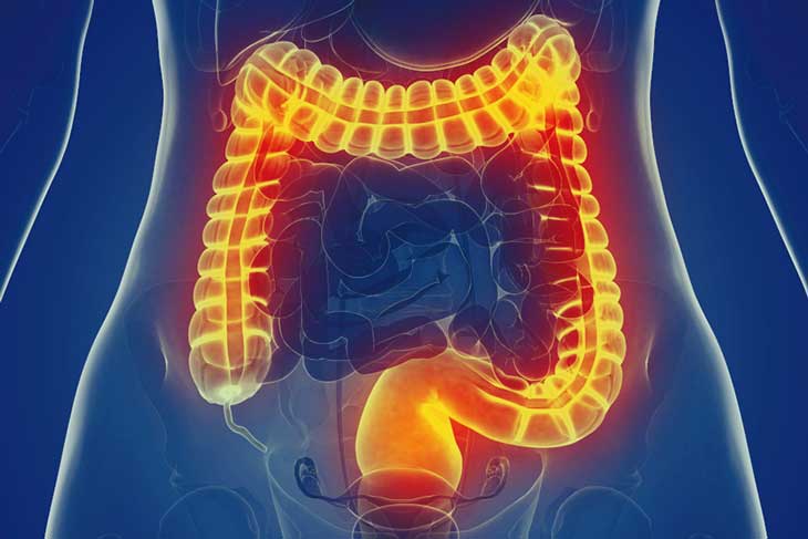 Hội chửng uột kích thích