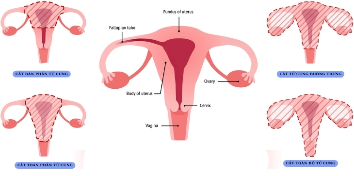Phẫu thuật cắt tử cung