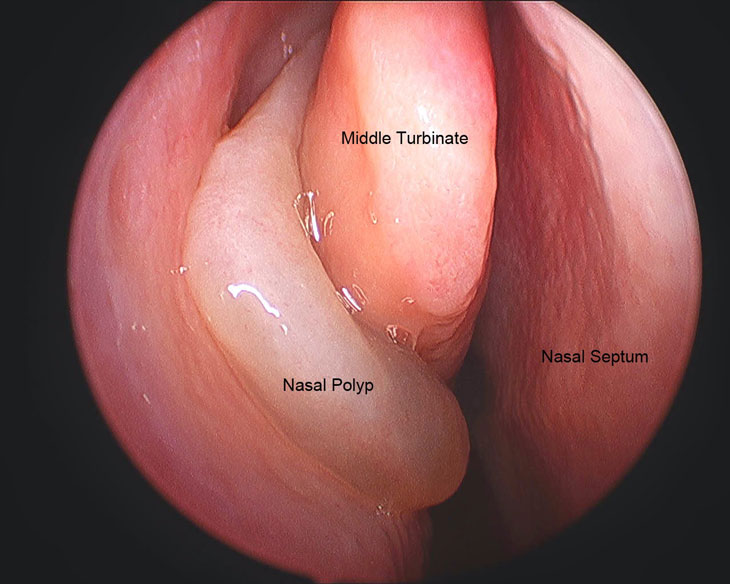 Polyp mũi