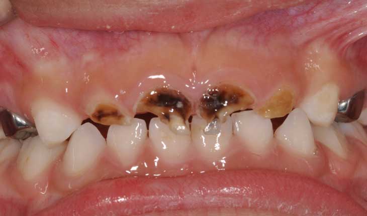 sâu răng do bú bình