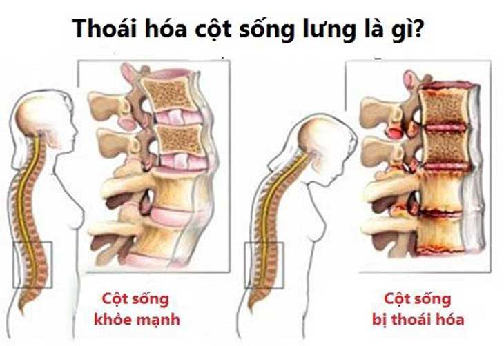 thoái hóa cốt sống