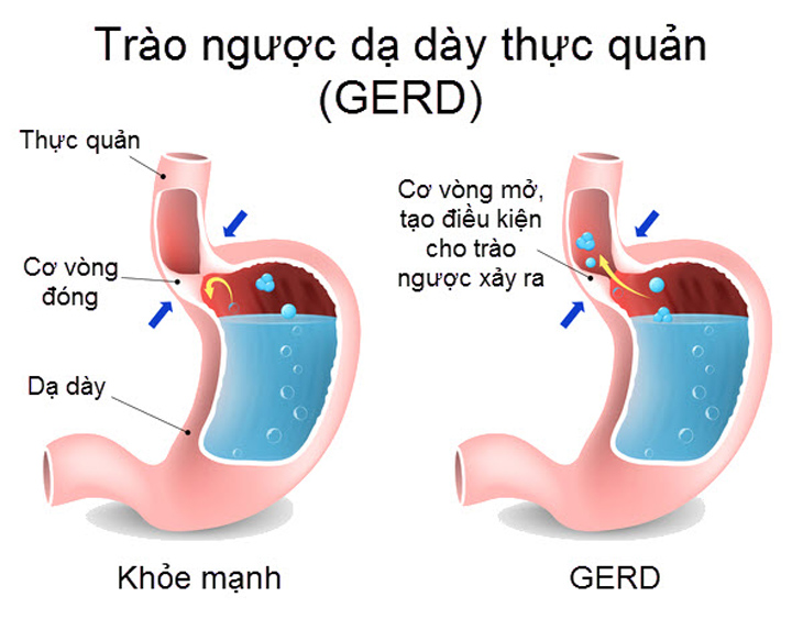 trào ngược dạ dày thực quản