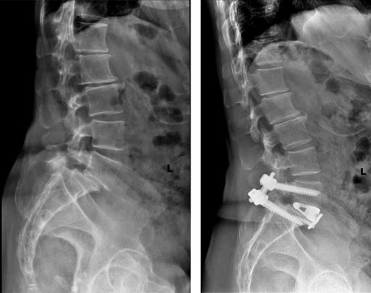Trượt đốt sống