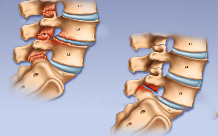 Trượt đốt sống