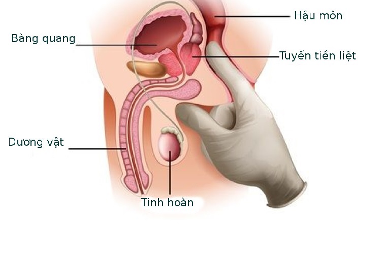 u xơ tiền liệt tuyến