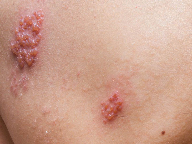Viêm da dạng herpes