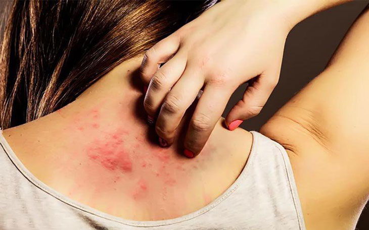 Viêm da dạng herpes
