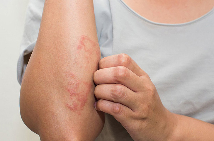 viem-da-do-tiep-xuc-con-trung