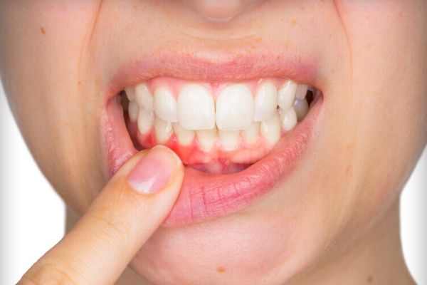 viêm lợi khi mang thai