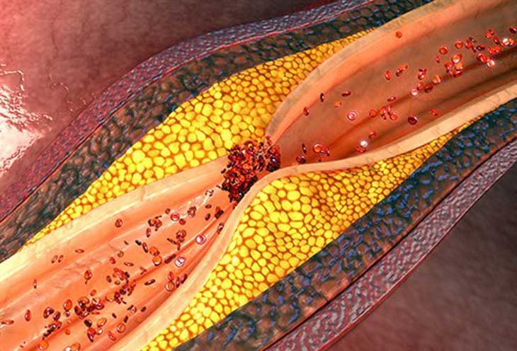 vữa xơ động mạch