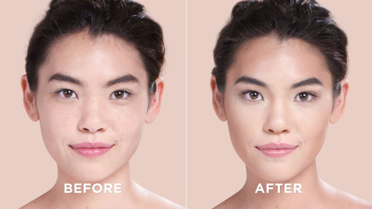 Nâng mũi đẹp tự nhiên