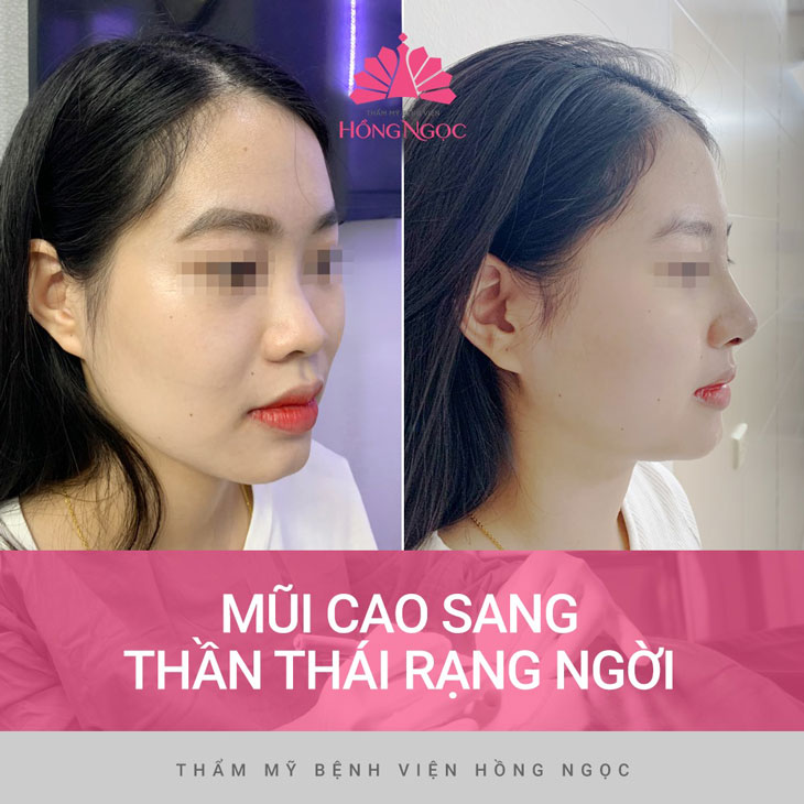 Nâng mũi đẹp tự nhiên