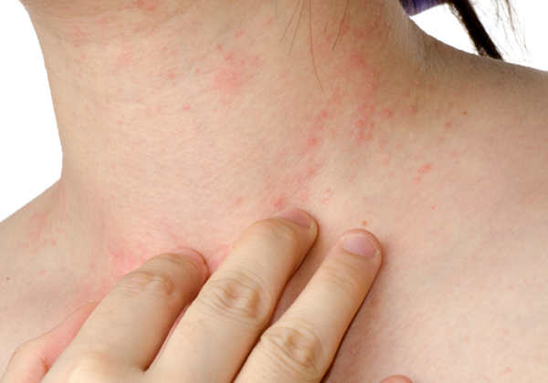 bệnh thủy đậu khi mang thai