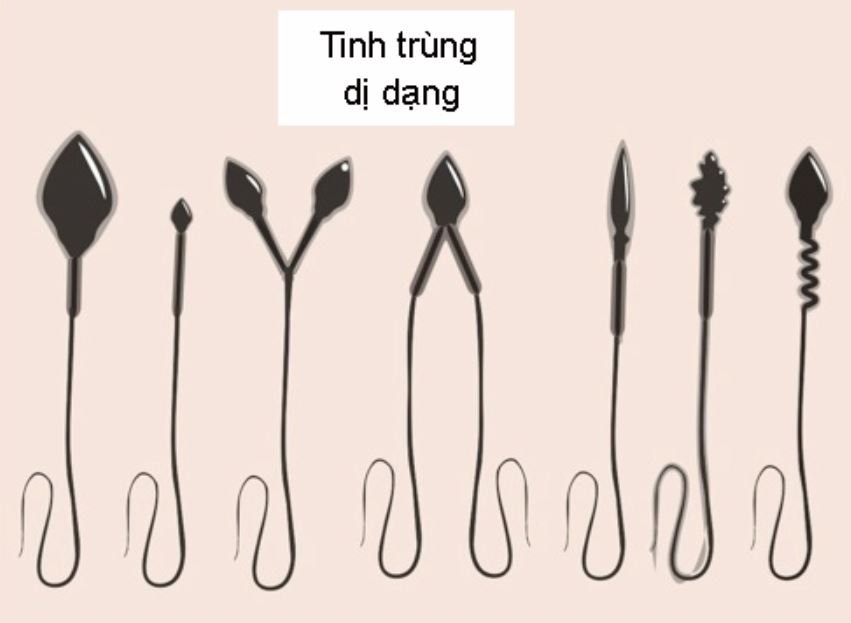 Tinh trùng dị ạng mức độ nhẹ có thể thực hiện IUI