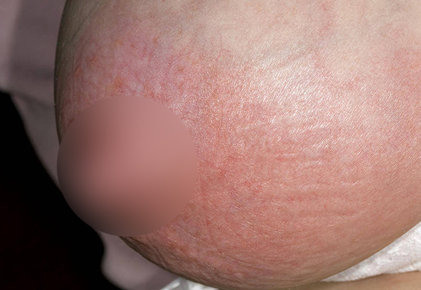 căng tức tuyến vú sau sinh