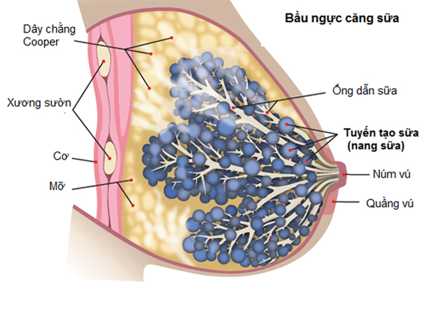 bầu ngực bị căng sữa