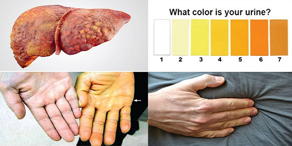 Triệu chứng của hội chứng gan thận