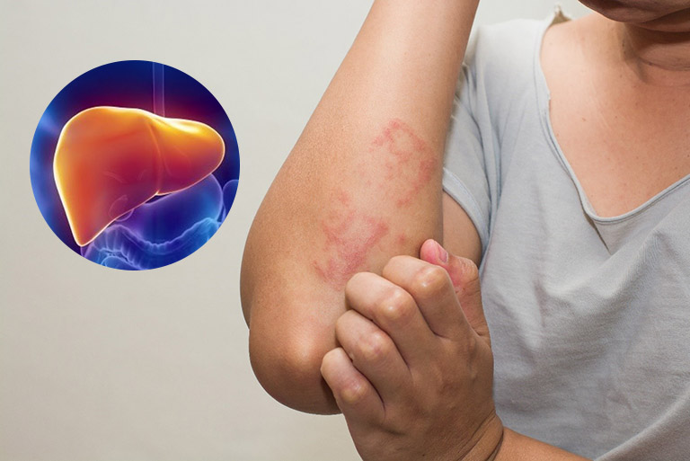 Rối loạn chức năng gan