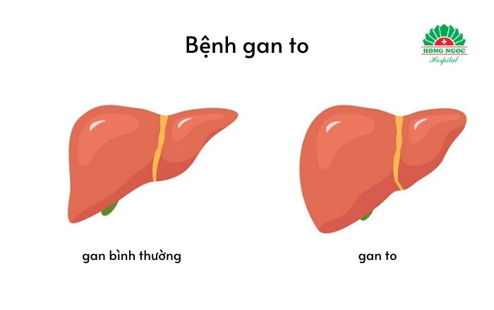 Bệnh gan to