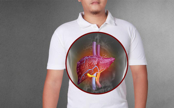 Suy gan cấp tính gây nên nhiều biến chứng nghiêm trọng