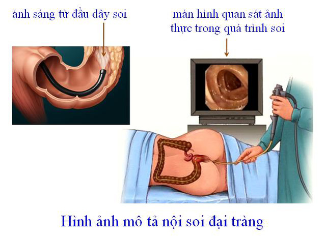 Minh họa nội soi đại tràng không gây mê