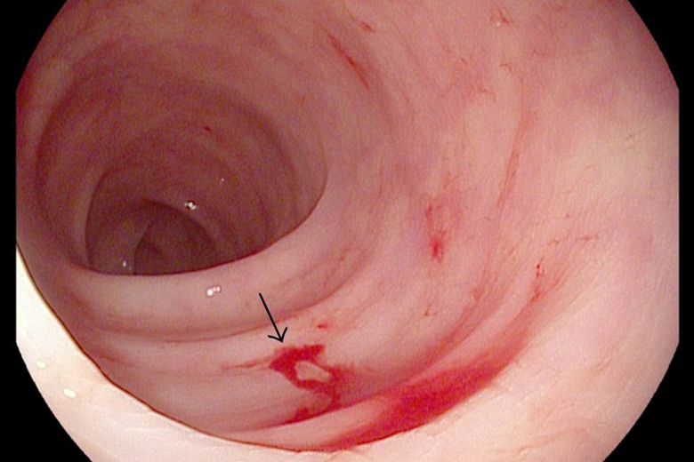 xuất huyết dạ dày