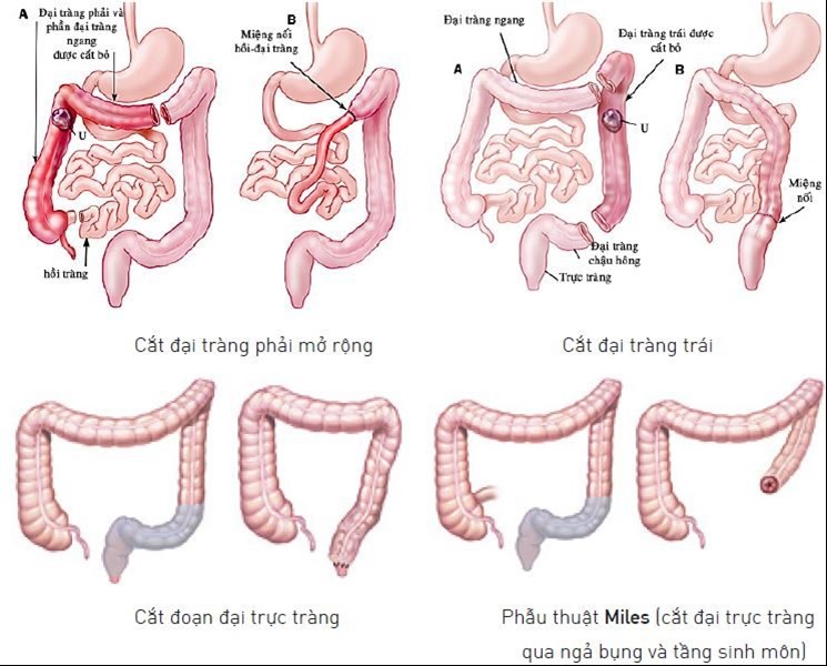 nội soi cắt đại tràng