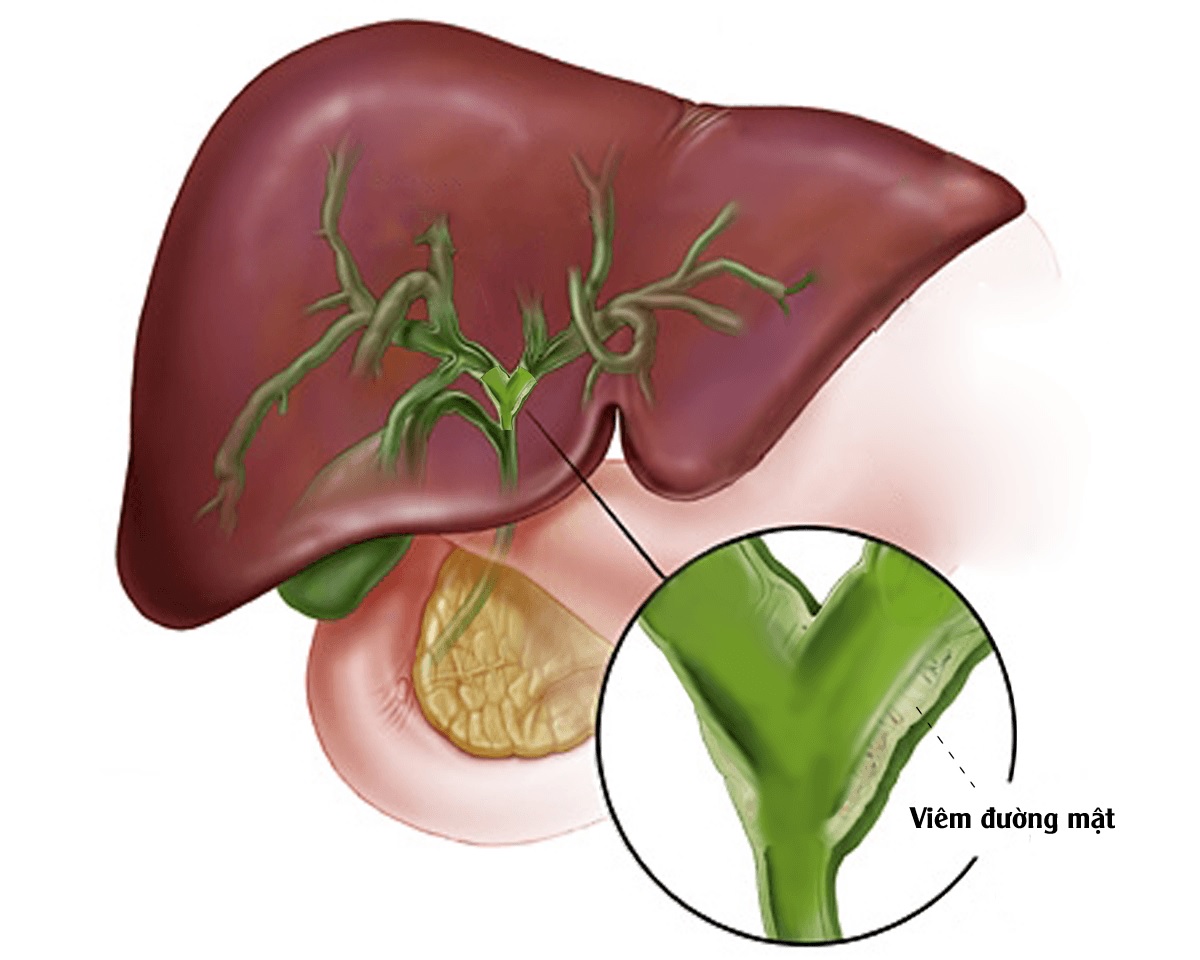 Viêm đường mật là biến chứng nguy hiểm của bệnh sỏi ống mật