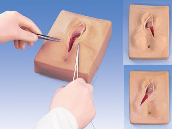 Khâu tầng sinh môn 