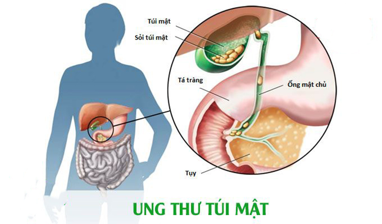 sỏi mật