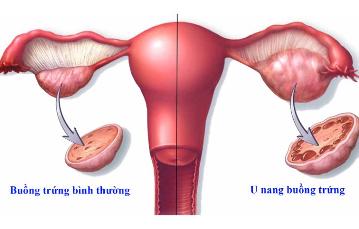 U nang tại buồng trứng