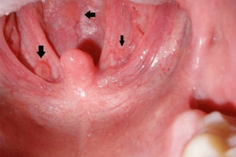 amidan nổi cục thịt