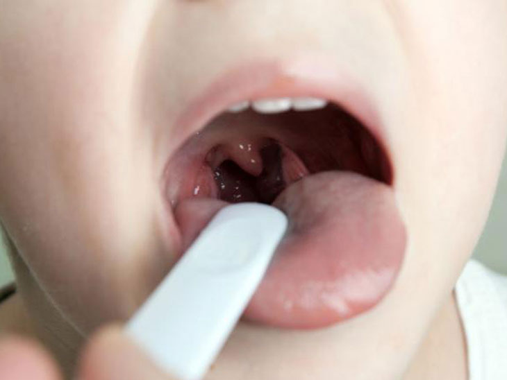 viêm amidan quá phát