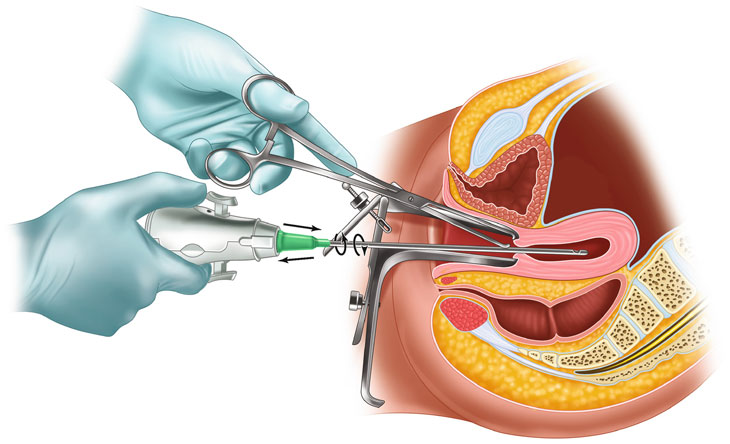 Hút thai 5 tuần tuổi