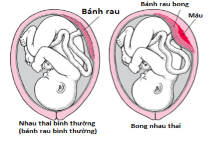 Dấu hiệu thai yếu