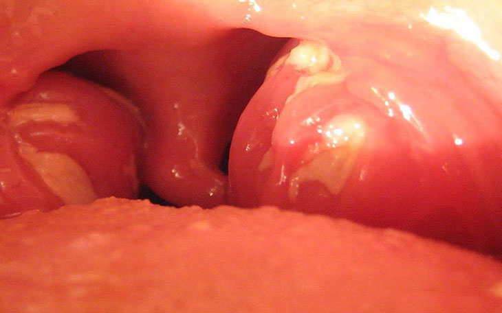 cac loai viêm amidan