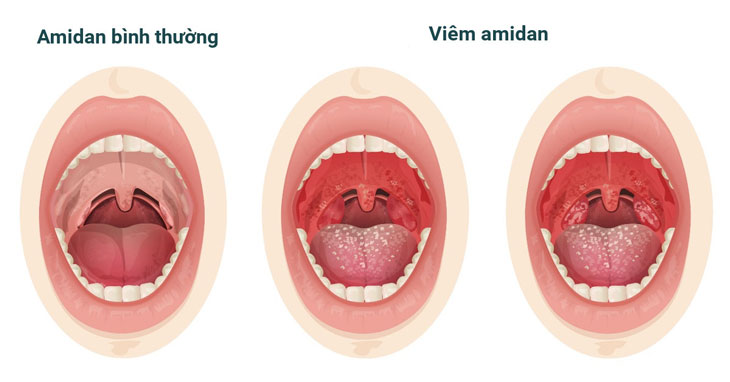 Viêm amidan cấp tính