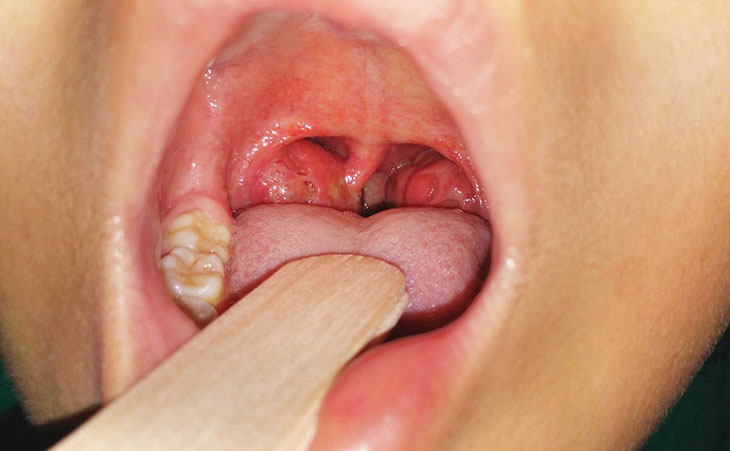 Viem Amidan Phi Dai O Tre Em 4