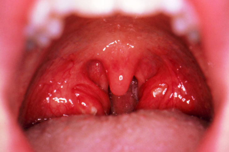 Viêm amidan và viêm họng