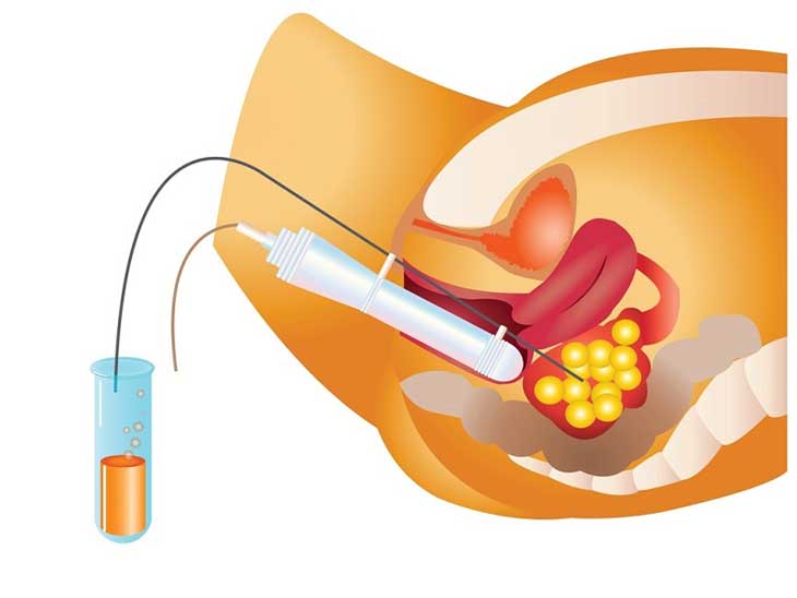 Buồn nôn sau 4 ngày chuyển phôi