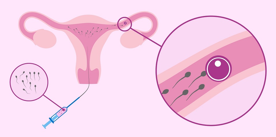 Cham soc ba bau sau thu tinh nhan tao